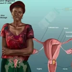 Cervical Cancer Awareness in Nigeria