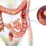 Nigerians Speak on Colorectal Cancer Awareness in Lagos