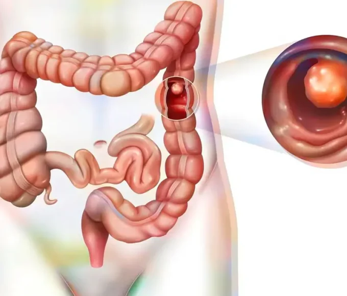 Nigerians Speak on Colorectal Cancer Awareness in Lagos