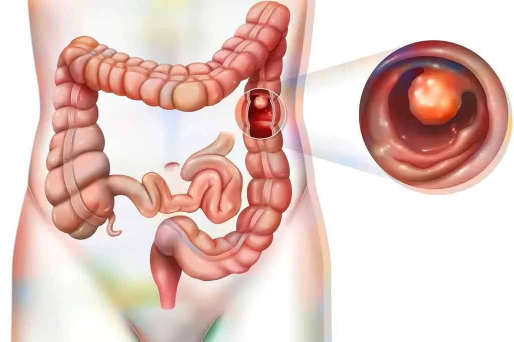 Nigerians Speak on Colorectal Cancer Awareness in Lagos